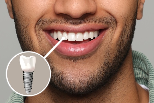 How Soon Can You Get Tooth Implants  After Extraction?